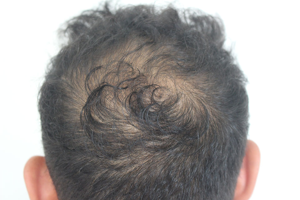 Crown of mans hair after hair loss treatment