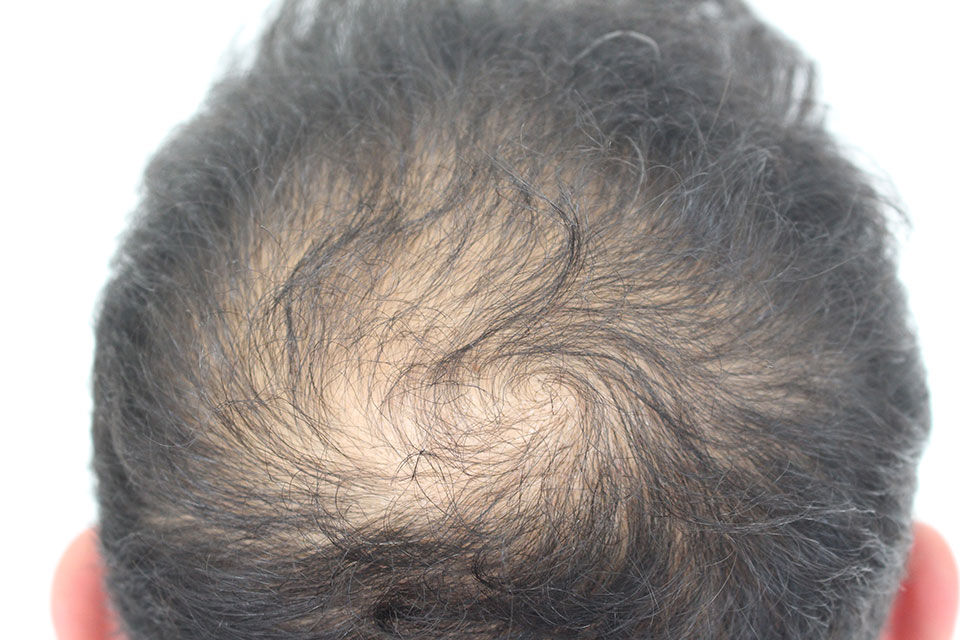 Crown of mans hair showing balding & hair loss